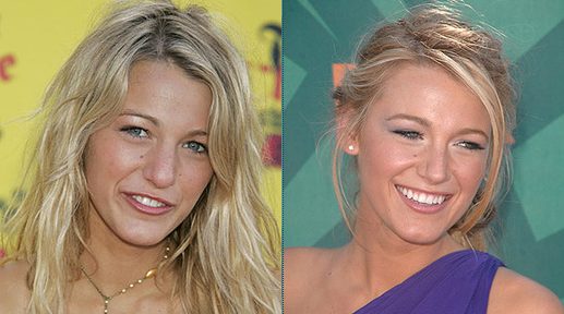 blake lively plastic surgery before after
